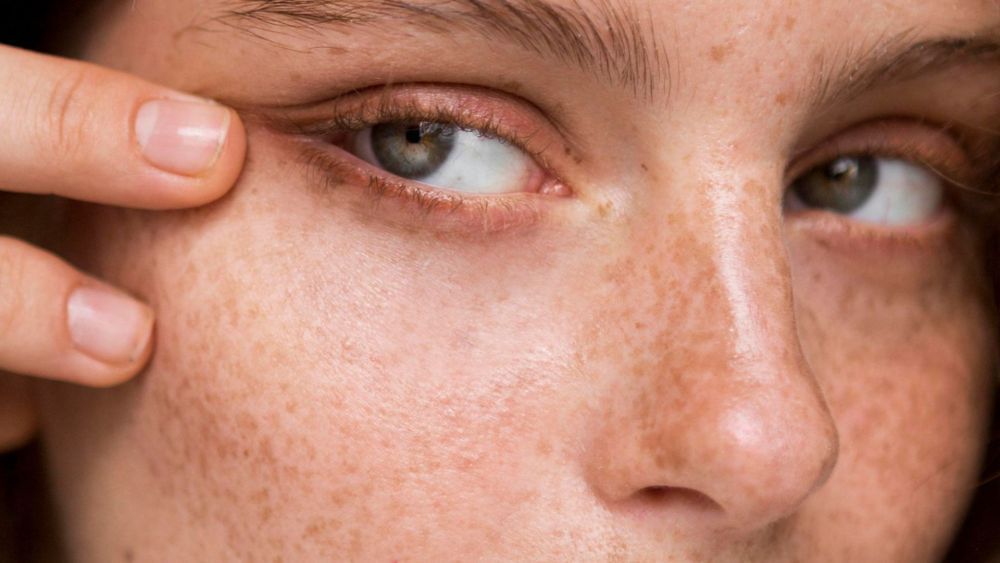 advanced-acne-scar-treatment-in-dubai-restore-smooth-clear-skin-big-0