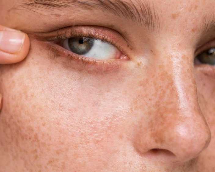 advanced-acne-scar-treatment-in-dubai-restore-smooth-clear-skin