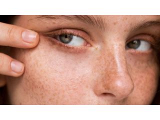 advanced-acne-scar-treatment-in-dubai-restore-smooth-clear-skin-small-0