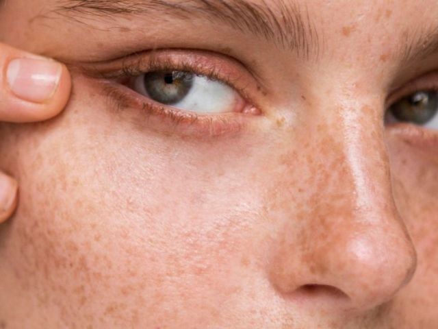advanced-acne-scar-treatment-in-dubai-restore-smooth-clear-skin