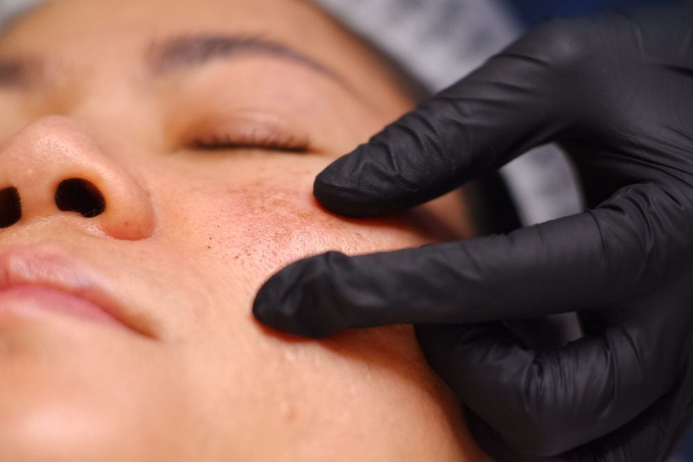 professional-solutions-for-melasma-treatment-in-dubai-big-0