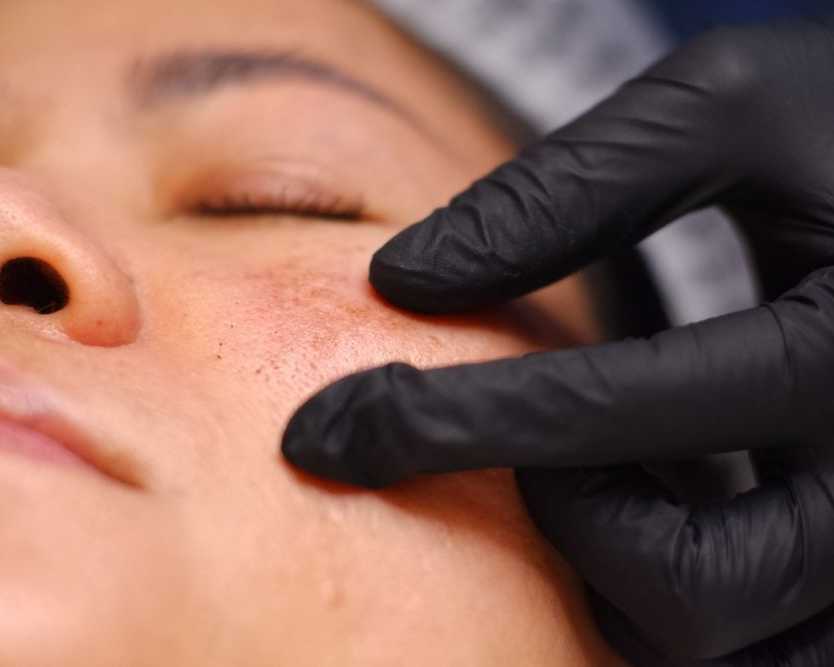 professional-solutions-for-melasma-treatment-in-dubai