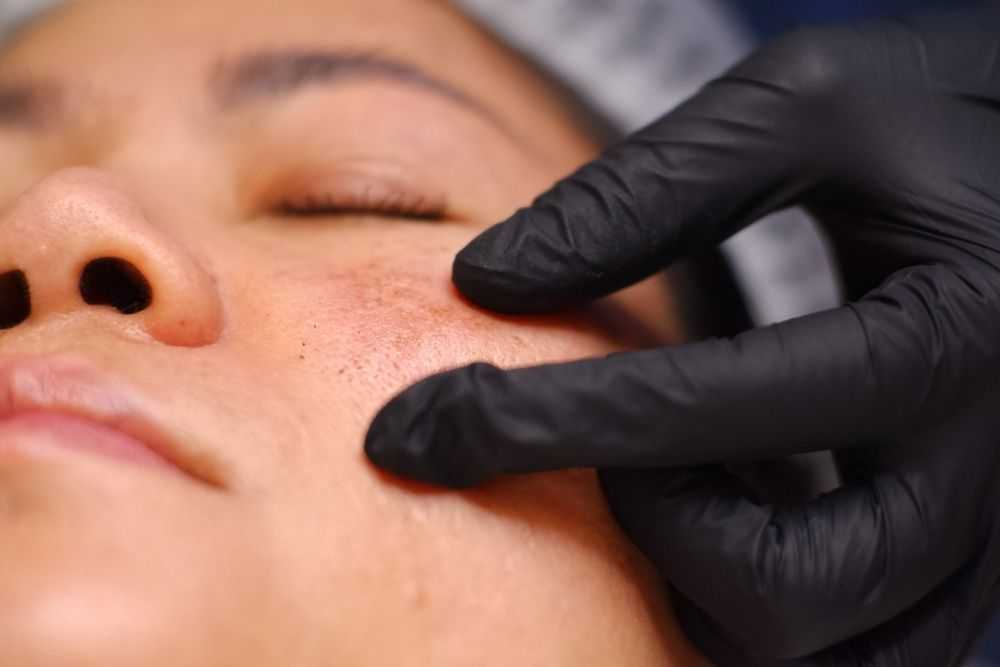 professional-solutions-for-melasma-treatment-in-dubai-big-0