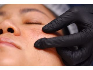 professional-solutions-for-melasma-treatment-in-dubai-small-0