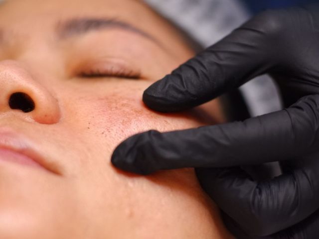 professional-solutions-for-melasma-treatment-in-dubai