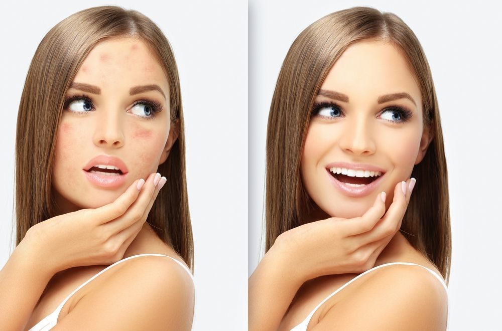 acne-vs-acne-scars-finding-the-right-treatment-for-clearer-skin-big-0