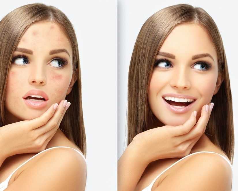 acne-vs-acne-scars-finding-the-right-treatment-for-clearer-skin
