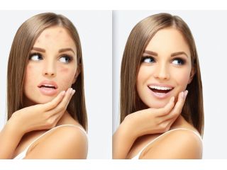 acne-vs-acne-scars-finding-the-right-treatment-for-clearer-skin-small-0