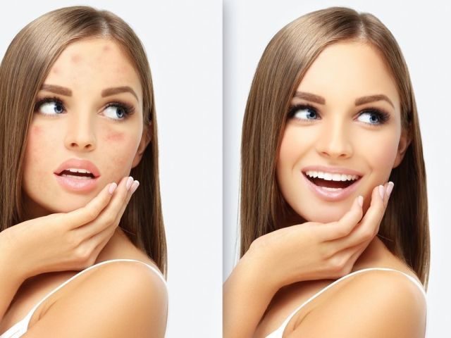 acne-vs-acne-scars-finding-the-right-treatment-for-clearer-skin