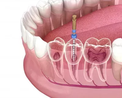 root-canal-treatment-dubai-big-0