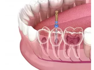 root-canal-treatment-dubai-small-0