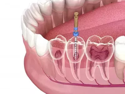 root-canal-treatment-dubai