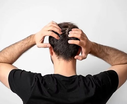 what-is-the-best-dandruff-treatment-for-men-big-0