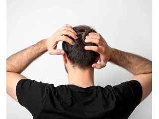 what-is-the-best-dandruff-treatment-for-men-small-0
