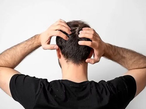 what-is-the-best-dandruff-treatment-for-men