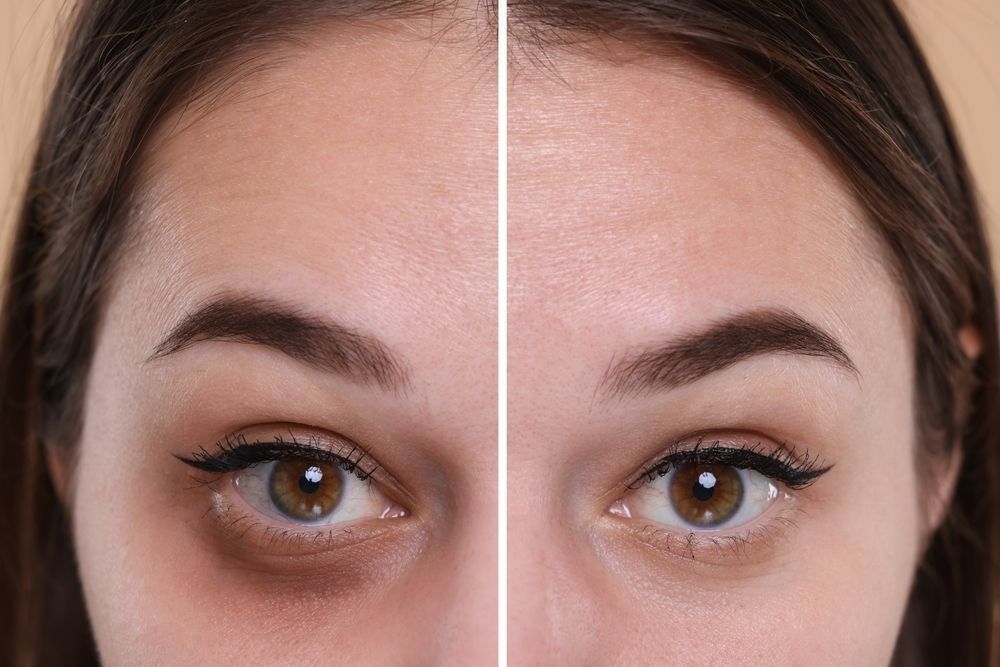 advanced-dark-circle-treatment-in-dubai-for-brighter-big-0