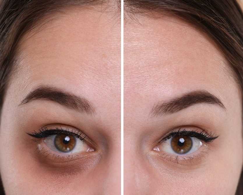advanced-dark-circle-treatment-in-dubai-for-brighter