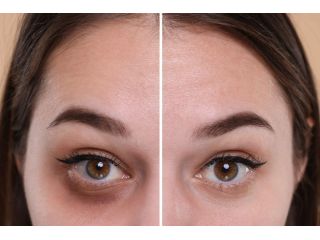 advanced-dark-circle-treatment-in-dubai-for-brighter-small-0