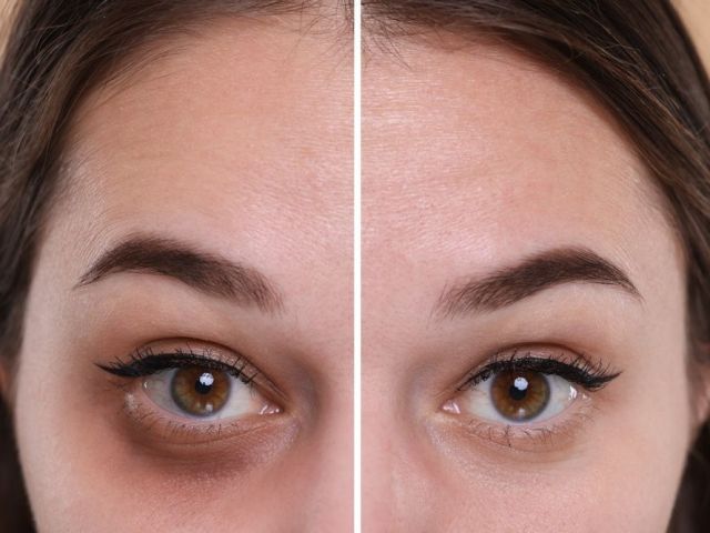 advanced-dark-circle-treatment-in-dubai-for-brighter