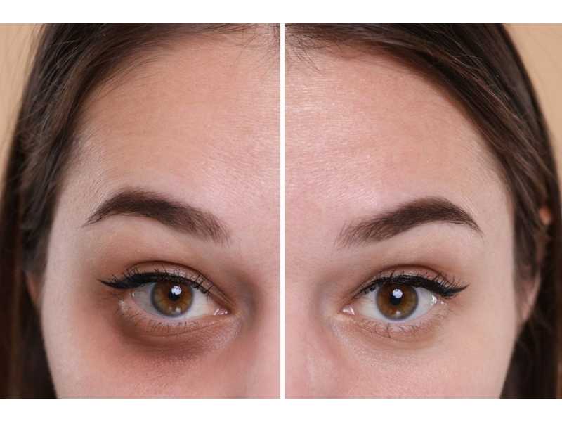 advanced-dark-circle-treatment-in-dubai-for-brighter-small-0