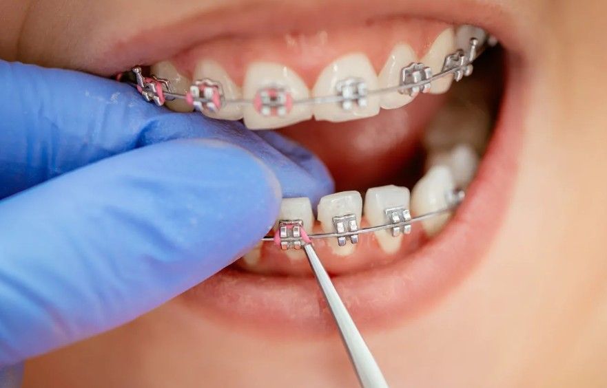 premium-orthodontic-braces-in-al-ain-big-0