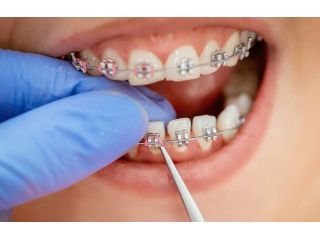 premium-orthodontic-braces-in-al-ain-small-0
