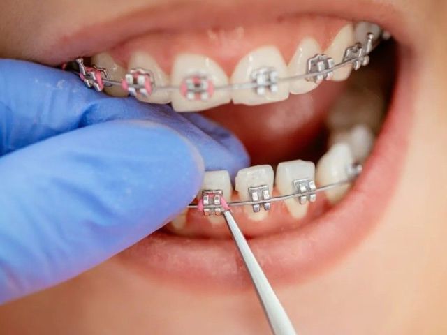 premium-orthodontic-braces-in-al-ain