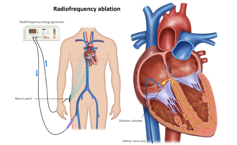 svt-ablation-abu-dhabi-big-0