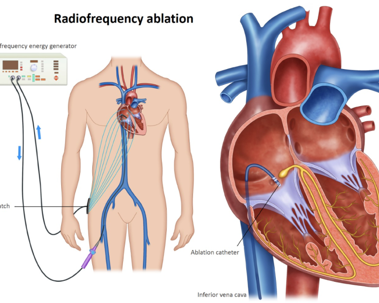 svt-ablation-abu-dhabi