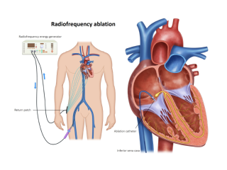 svt-ablation-abu-dhabi-small-0