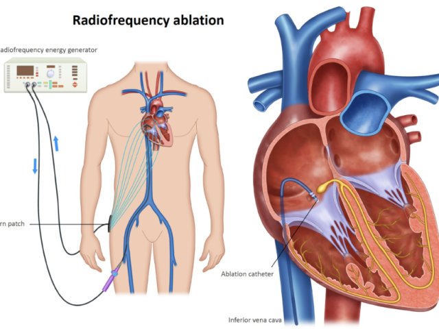 svt-ablation-abu-dhabi