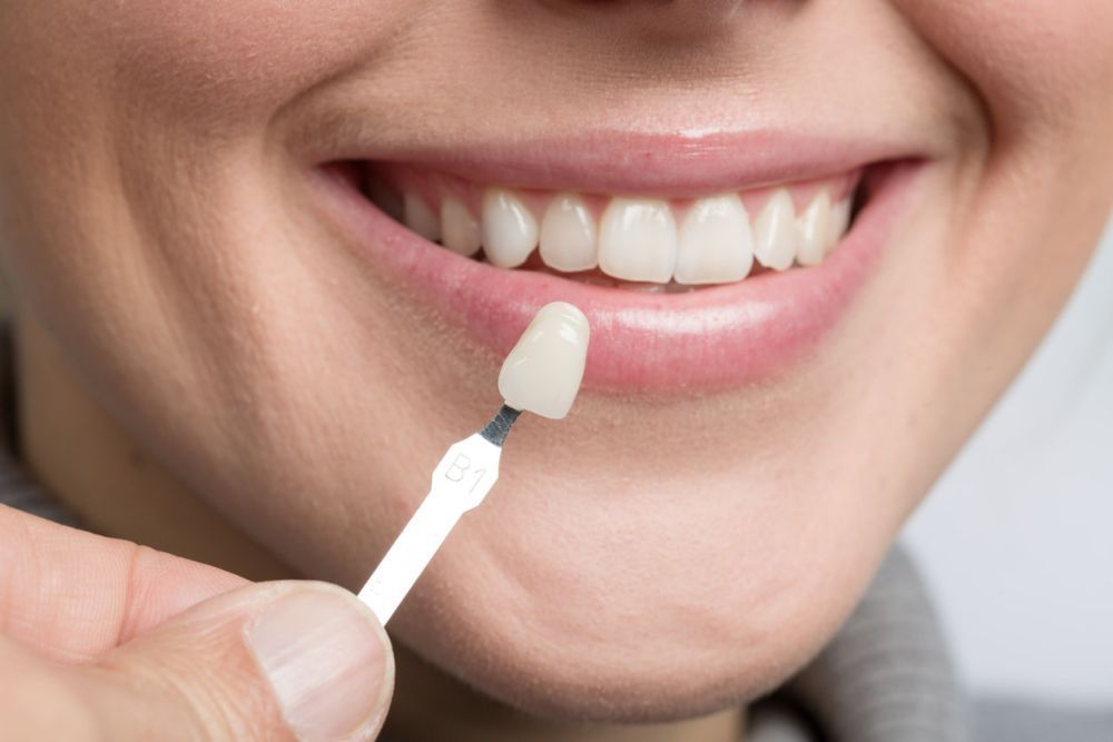 dental-veneers-big-0