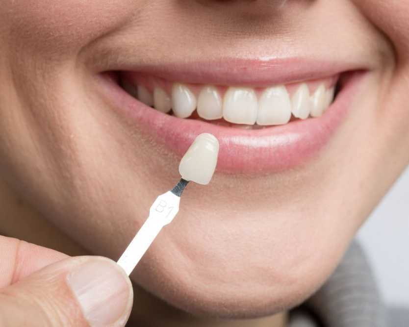 dental-veneers