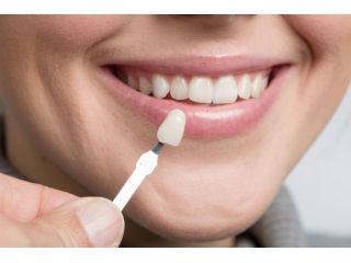 dental-veneers-small-0