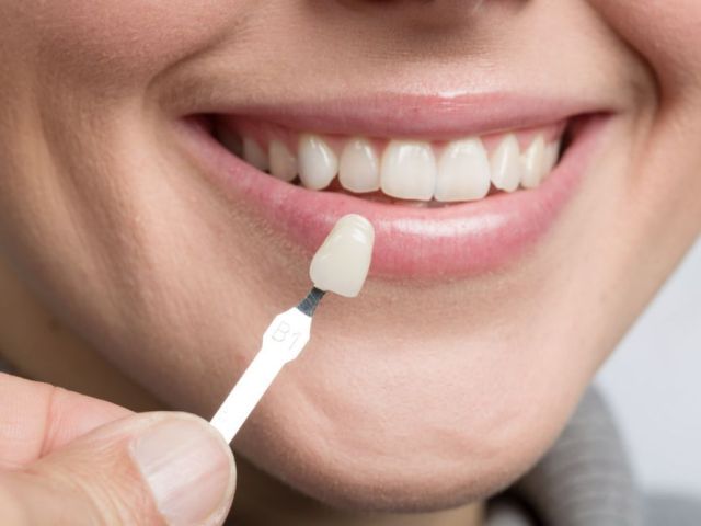 dental-veneers