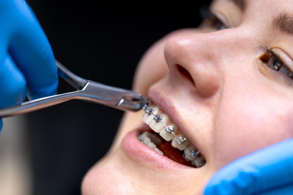 straighten-your-smile-with-braces-in-dubai-big-0
