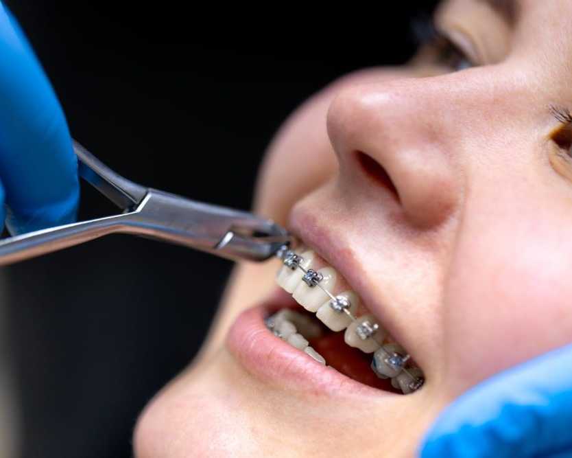 straighten-your-smile-with-braces-in-dubai
