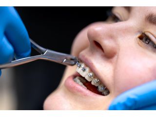 straighten-your-smile-with-braces-in-dubai-small-0