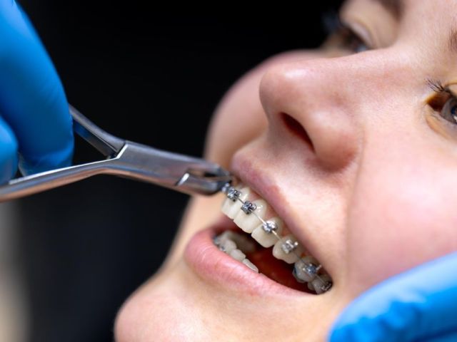 straighten-your-smile-with-braces-in-dubai