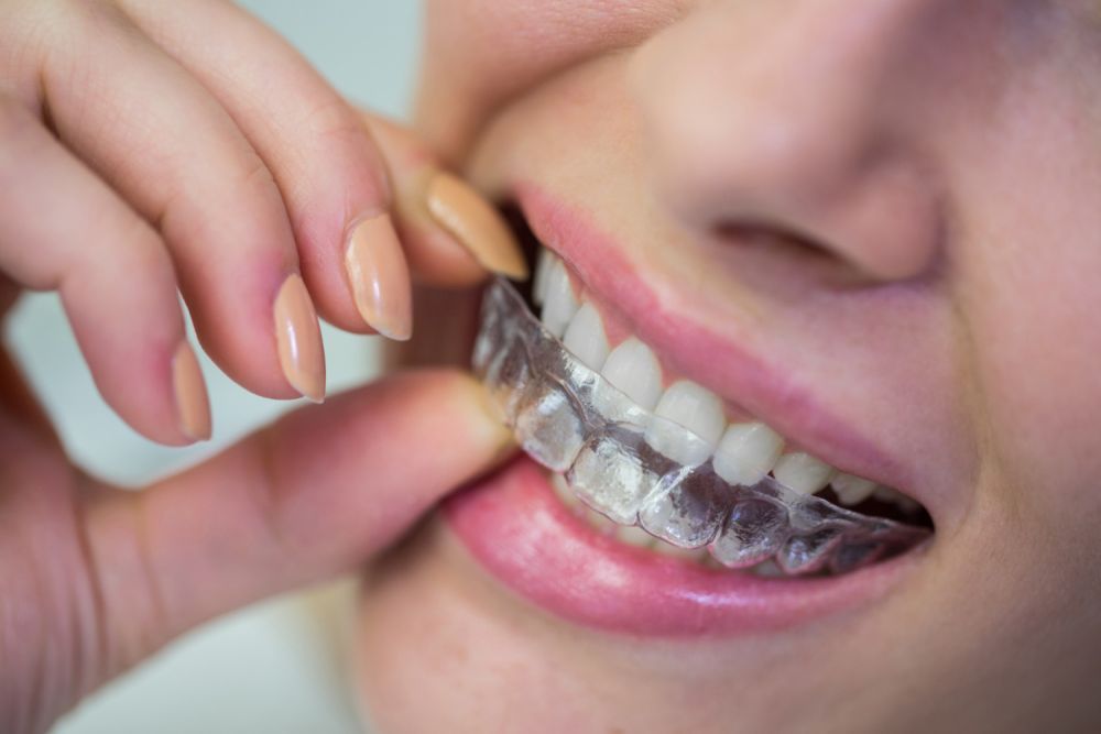 invisible-smile-transformation-with-clear-aligners-in-dubai-big-0