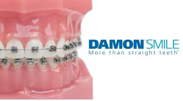 advanced-damon-braces-treatment-services-in-jumeirah-dubai-big-0