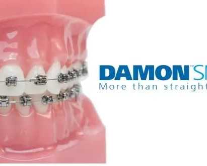 advanced-damon-braces-treatment-services-in-jumeirah-dubai