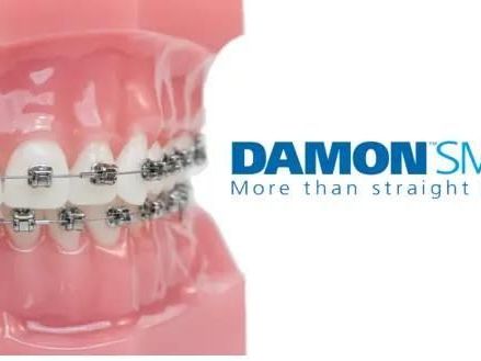 advanced-damon-braces-treatment-services-in-jumeirah-dubai