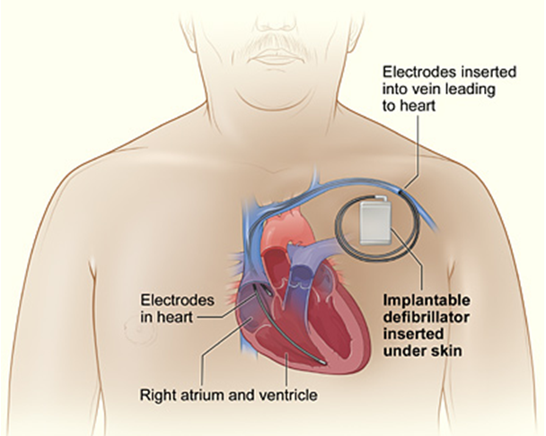 icd-surgery-in-abu-dhabi