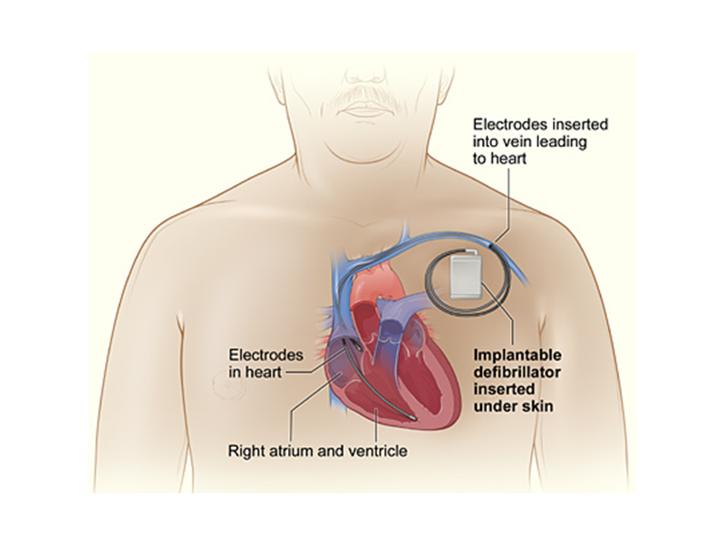 icd-surgery-in-abu-dhabi-small-0