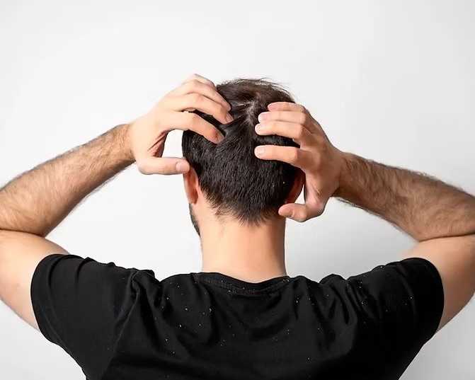 why-should-men-choose-professional-dandruff-treatment-services