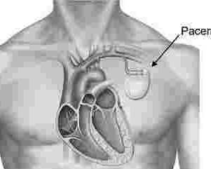 heart-pacemaker-surgery-in-uae-expert-cardiac-care