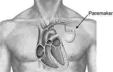 heart-pacemaker-surgery-in-uae-expert-cardiac-care-big-0