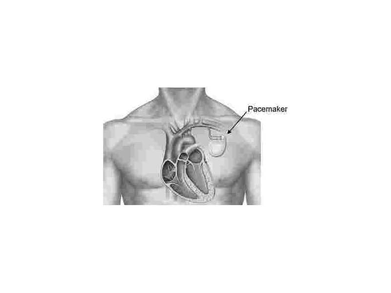 heart-pacemaker-surgery-in-uae-expert-cardiac-care-small-0
