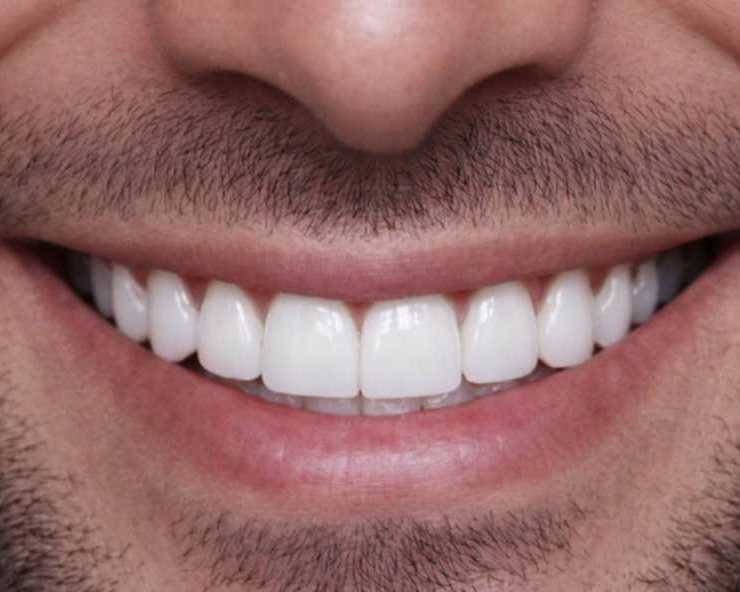 dental-veneers-clinic-near-dubai-marina-for-a-perfect-smile
